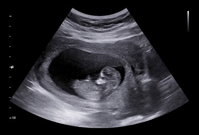 Ultrasound & 2D Echo
